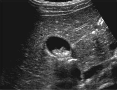 Gall Bladder Stone 
