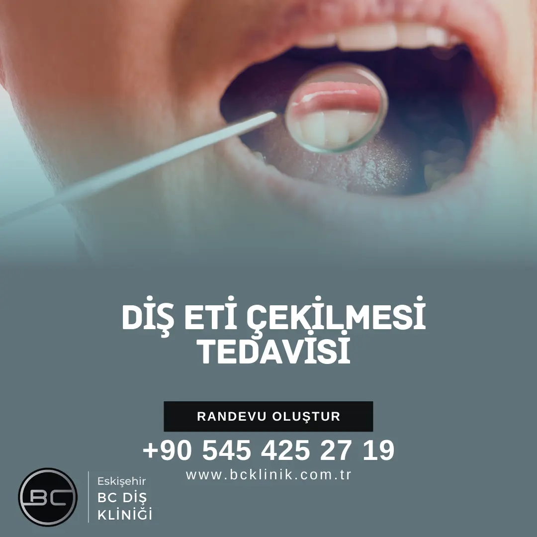 Diş Eti Çekilmesi Tedavisi Ameliyatı