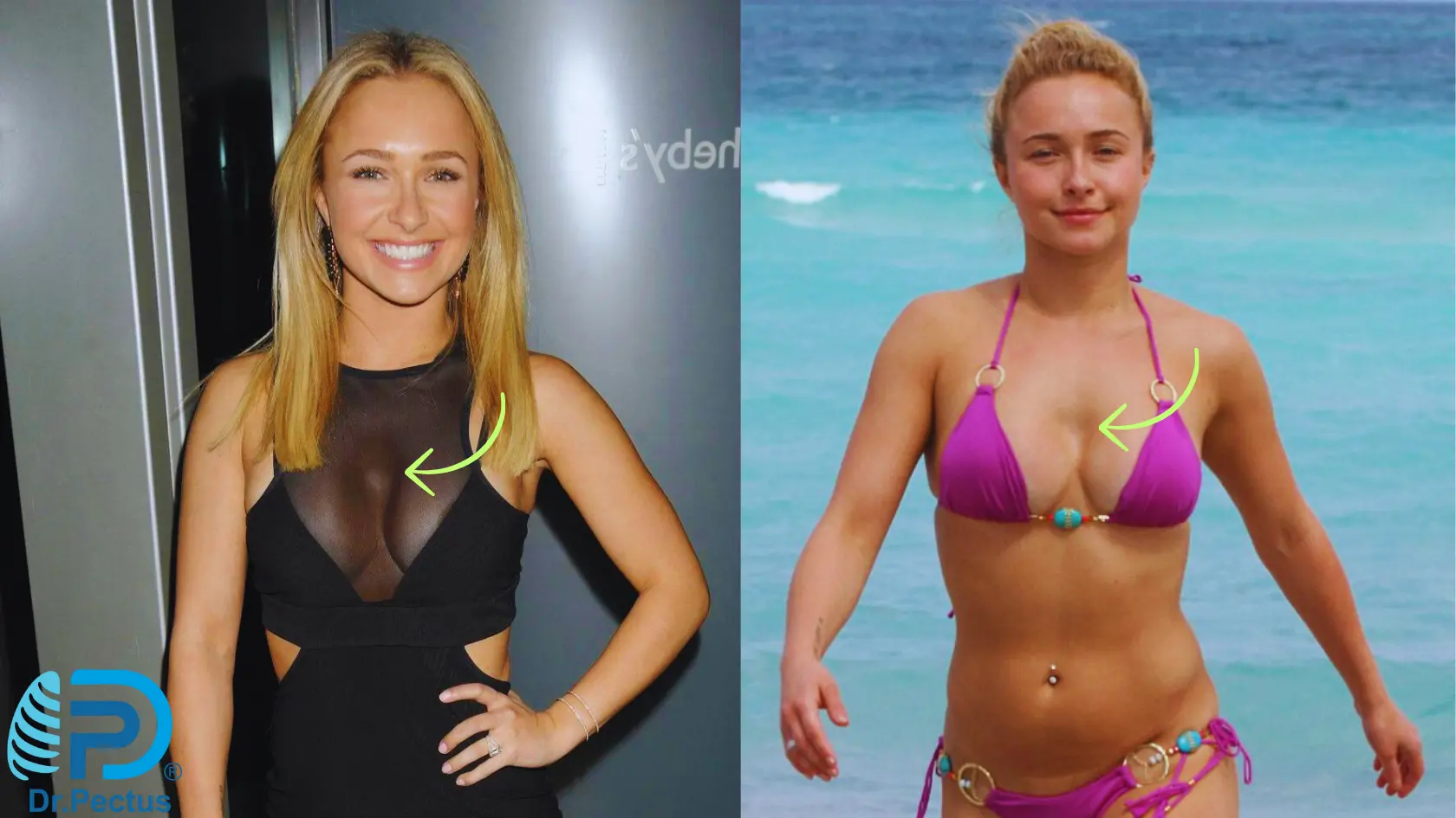 Hayden Panettiere Pectus Excavatum