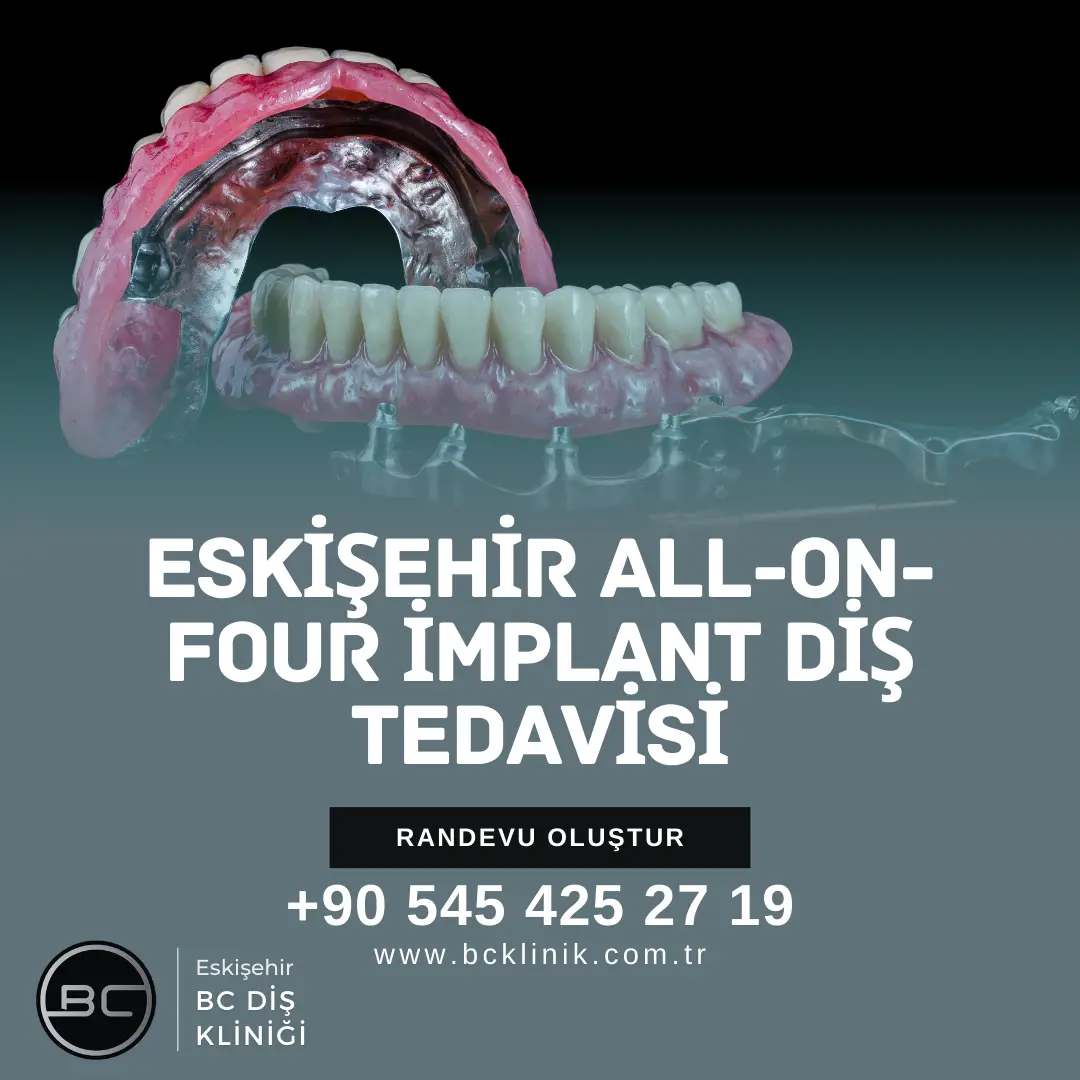 Eskişehir All-on-Four İmplant Diş
