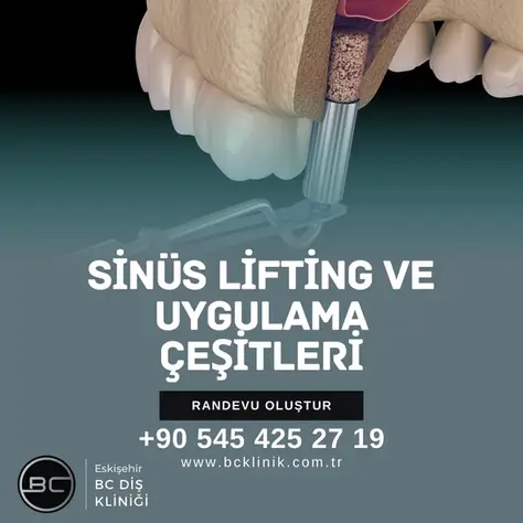 Sinüs Lifting ve Uygulama Çeşitleri