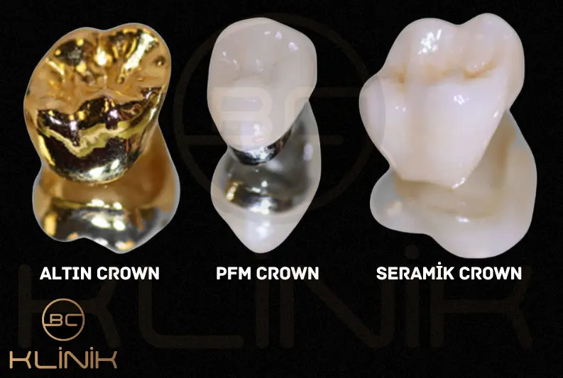 altın crown - metal destekli crown - seramik kaplama