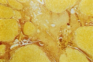 Light yellow color compared to surrounding liver tissue