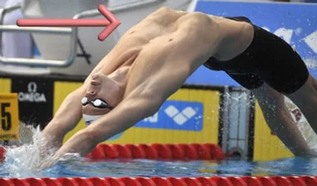 Bastian Lijesen with Pectus Excavatum