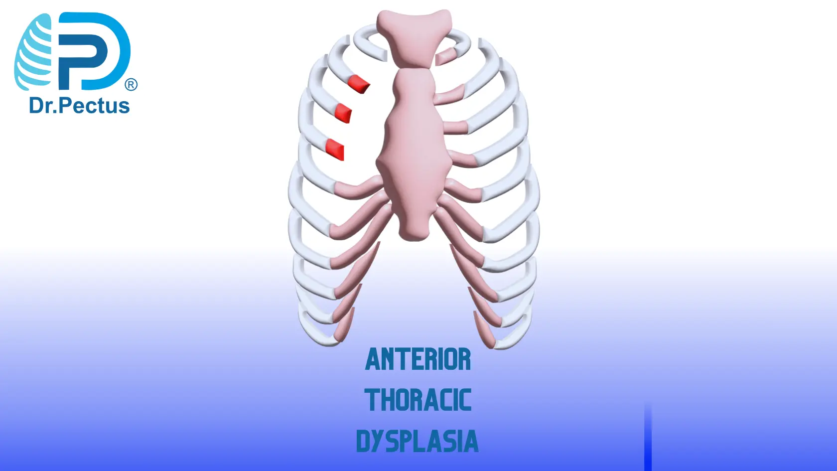 Pectus Excavatum Sunken Chest Causes And Risk Factors vrogue.co