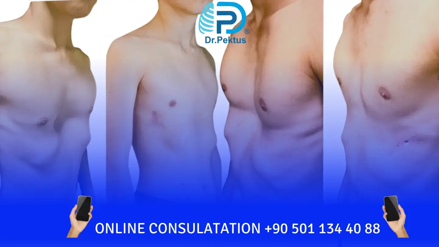 Pectus Excavatum surgery before and after in Turkery