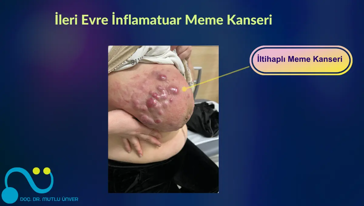 kanserli memenin fotoğrafları