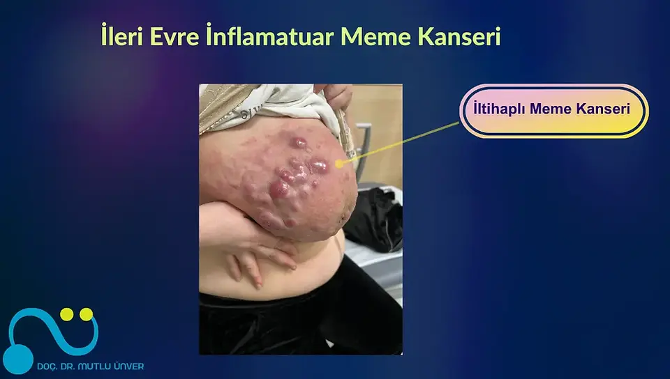 kanserli memenin fotoğrafları