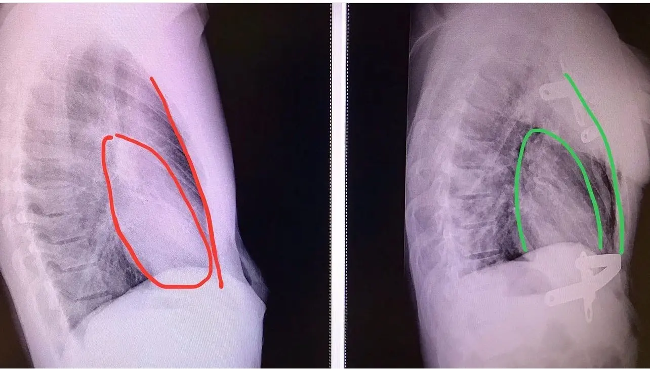 acquired platythorax-anteroposterior flattening of the chest wall