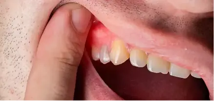 Diş Taşı (Tartar) Hangi Hastalıklara Yol Açar-izmir,çiğli