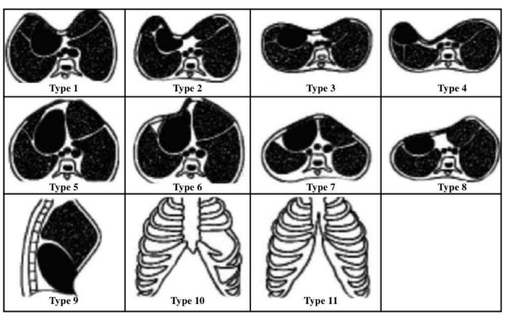 What is Platythorax?