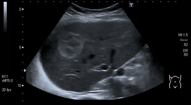 Gewöhnlich gut umschriebene, homogene, hypoechoic lesion (blass)