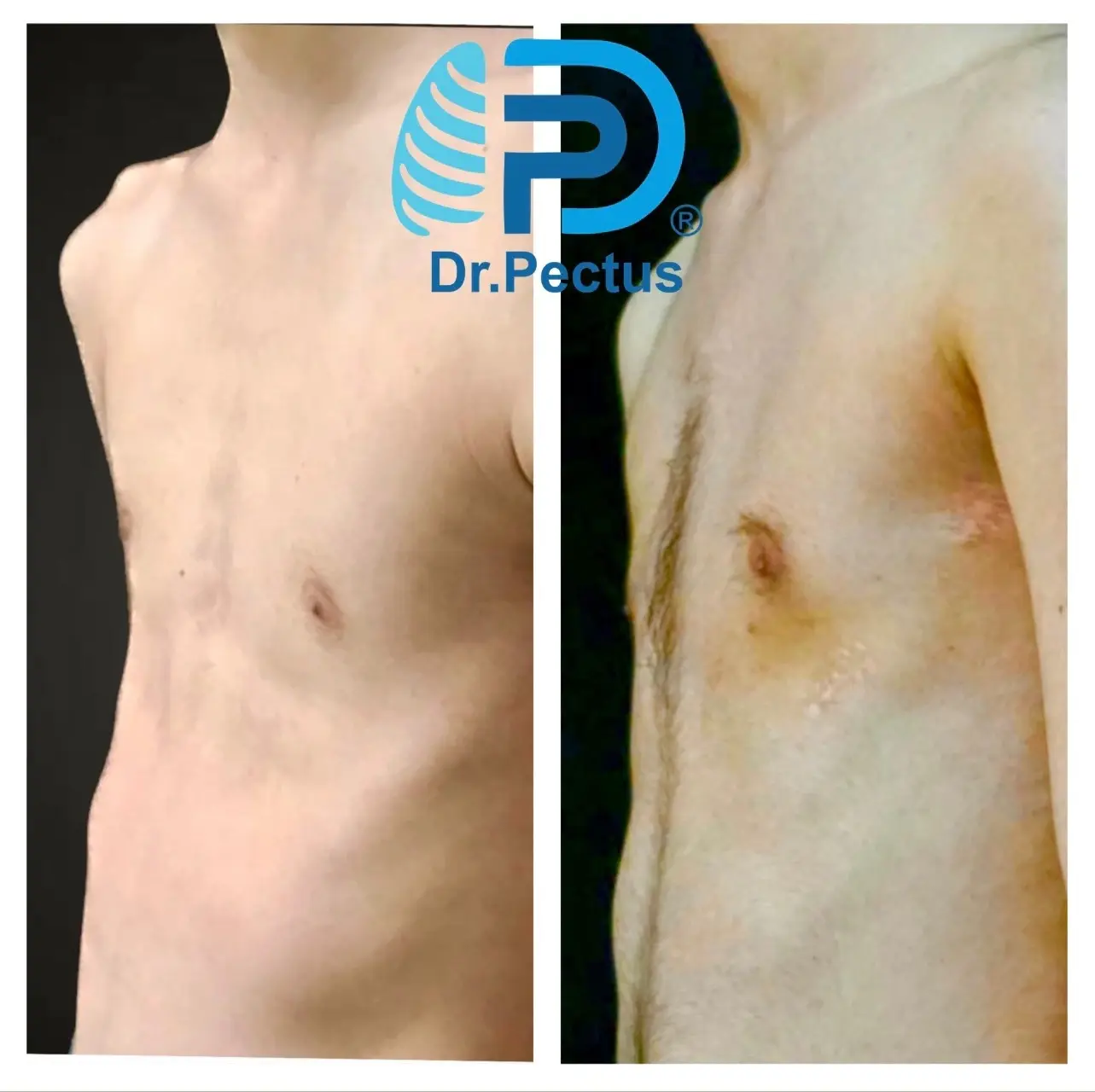acquired platythorax-anteroposterior flattening of the chest wall
