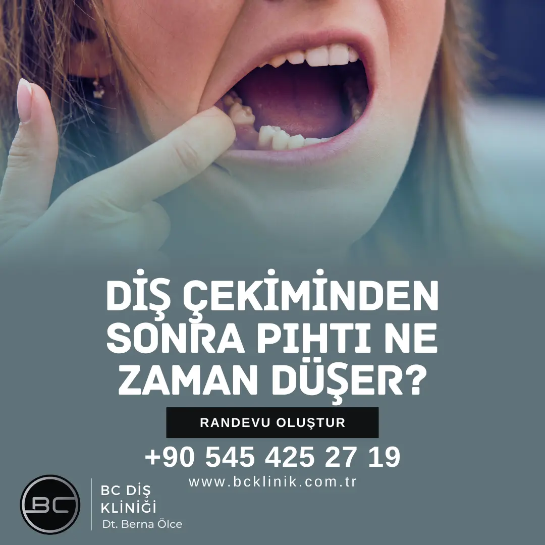Diş Çekiminden Sonra Pıhtı Ne Zaman Düşer?
