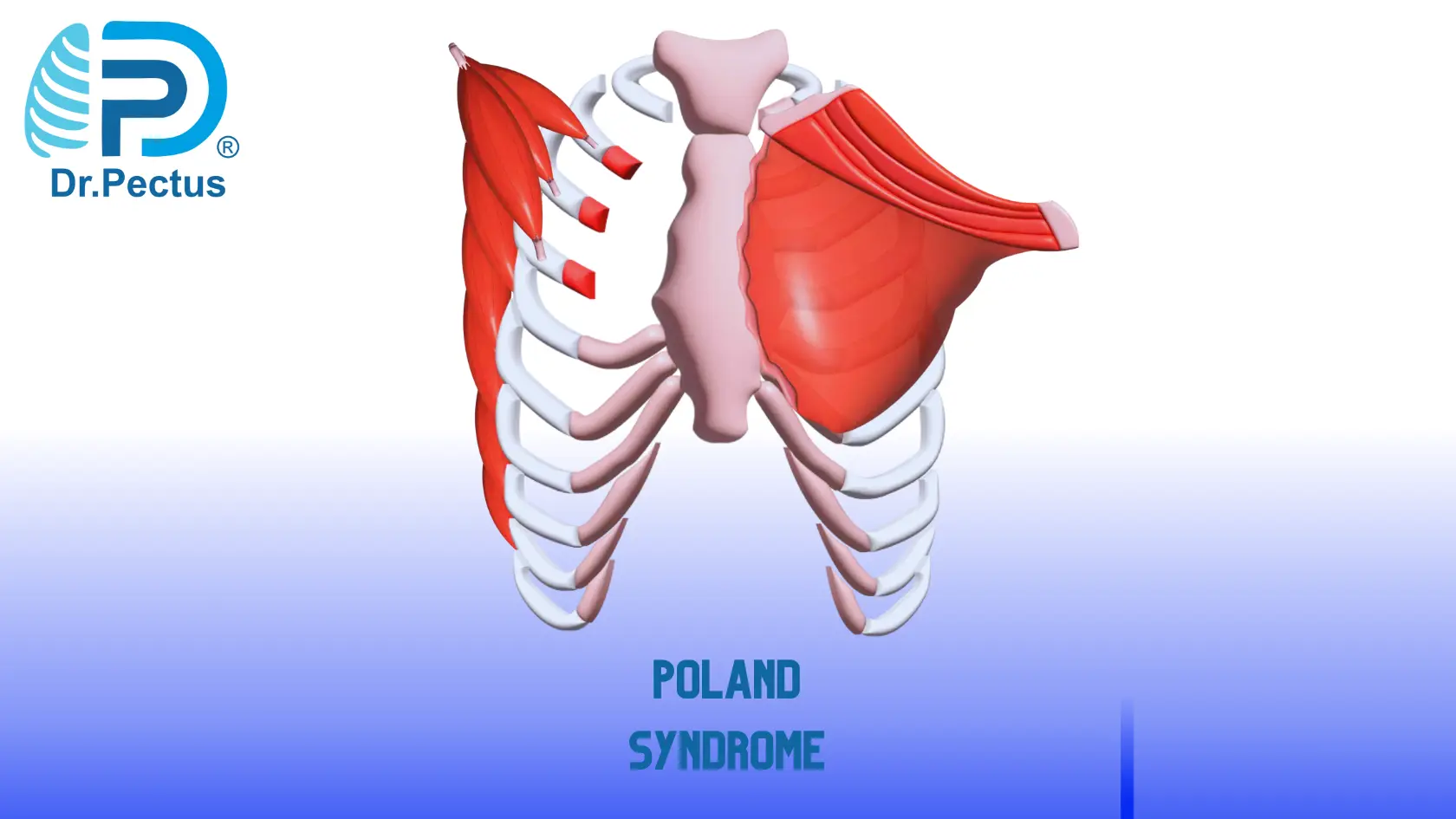 Pectus Excavatum (Sunken Chest) Causes and Risk Factors