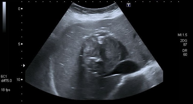 Gewöhnlich gut umschriebene, homogene, hypoechoic lesion (blass)