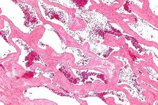 Cavernous vascular spaces of variable size lined by smooth endothelial cells