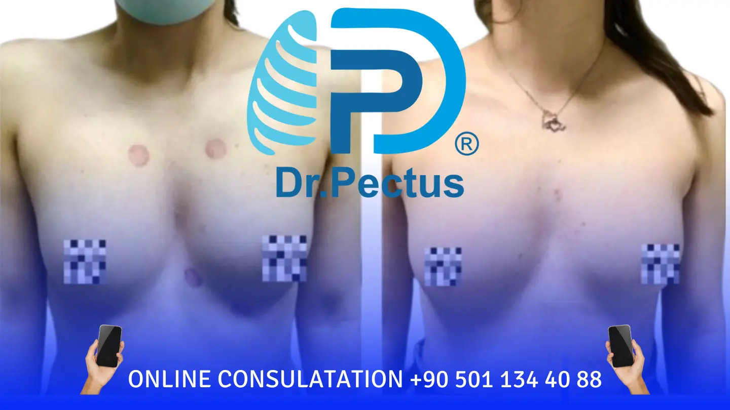 Pectus Excavatum Surgery woman in turkey