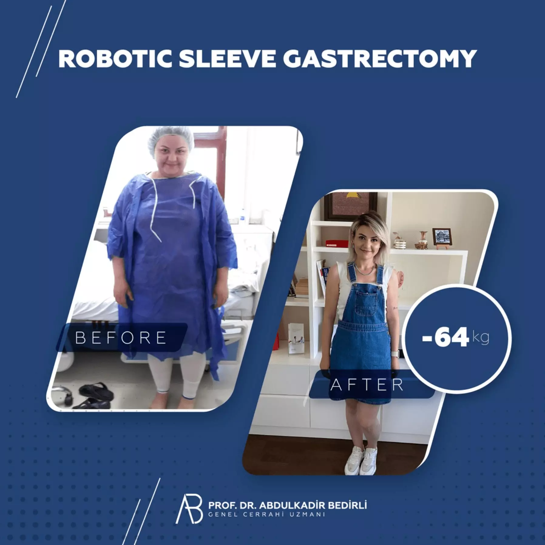 obezite ameliyat sonrası Prof.Dr.A.Bedirli