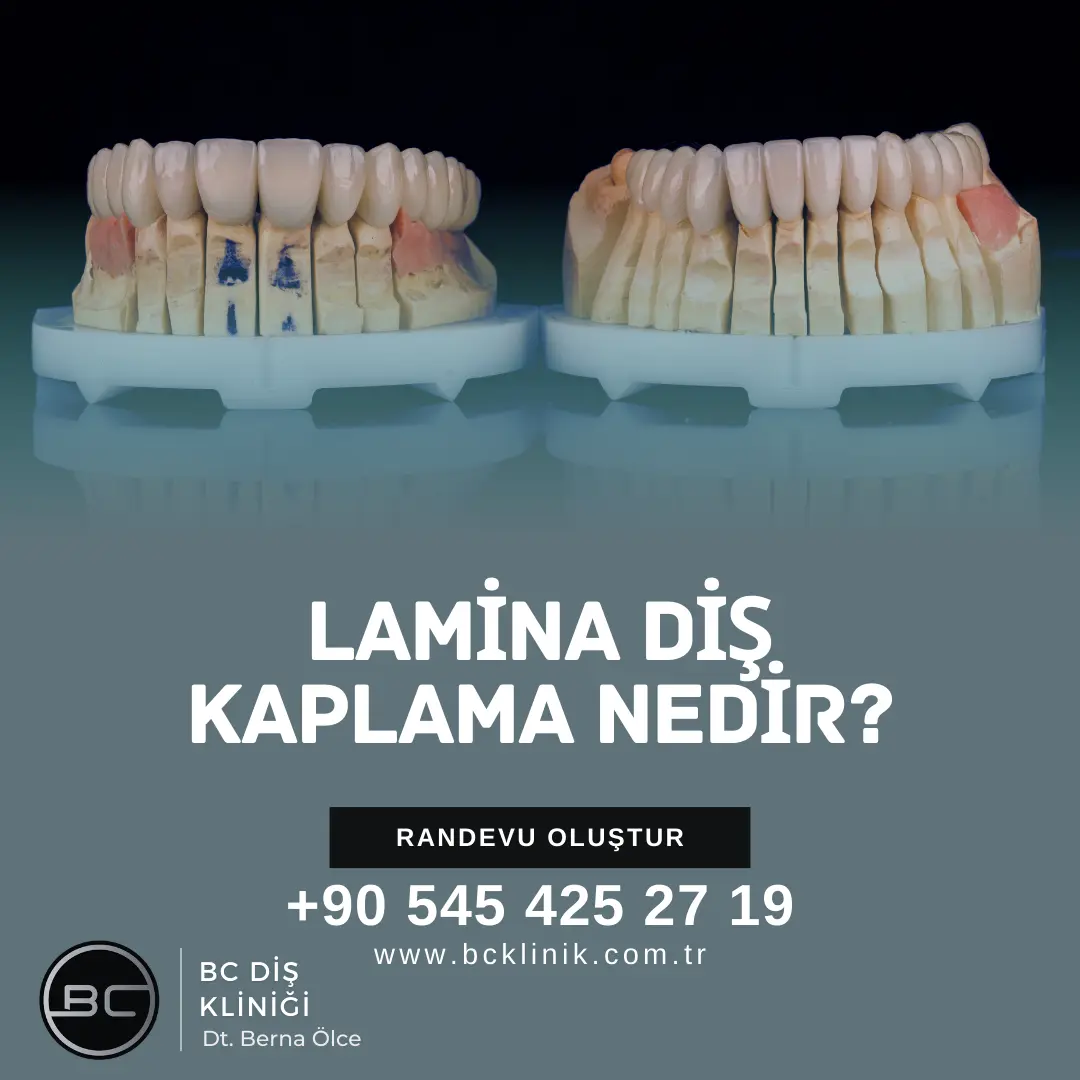 ayrık diş (diastema) tedavisi