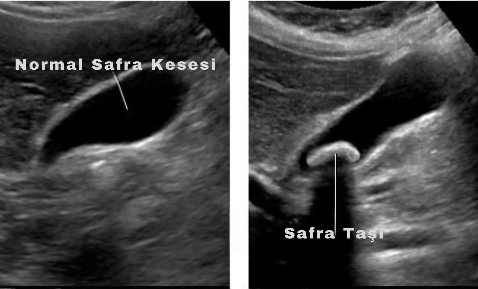 Safra Kesesi Taşı 7