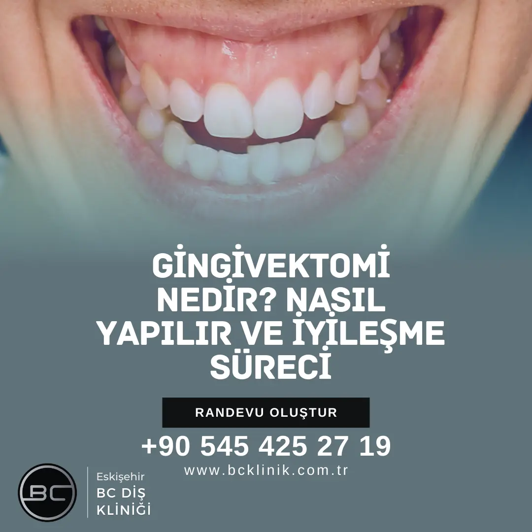 Gingivektomi Nedir? Nasıl Yapılır ve İyileşme Süreci