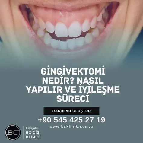 Gingivektomi Nedir? Nasıl Yapılır ve İyileşme Süreci