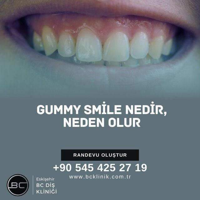Gummy Smile Nedir, Neden Olur ve Tedavi Seçenekleri