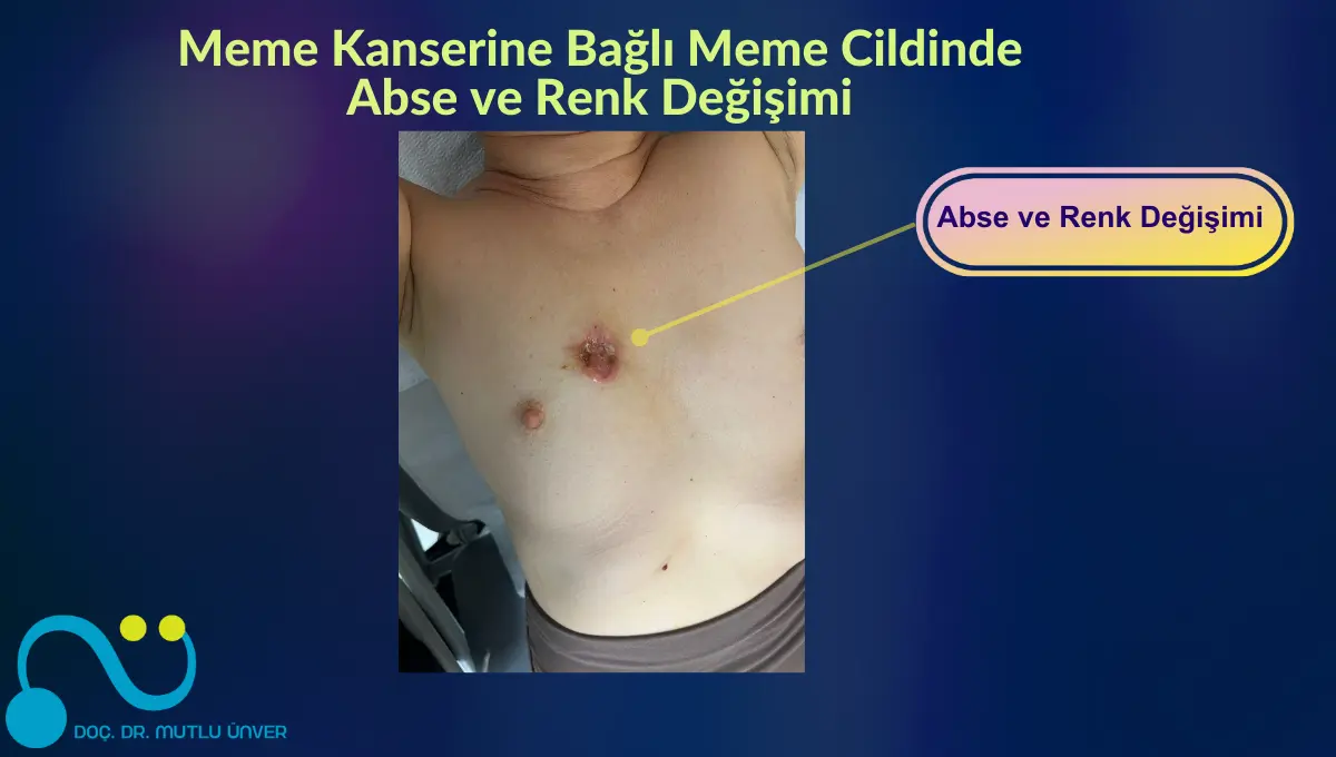 kanserli memenin fotoğrafları - Meme Kanseri