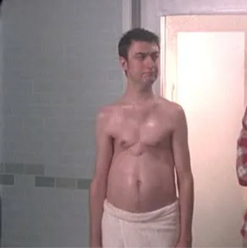 Sean Gunn with Pectus Excavatum