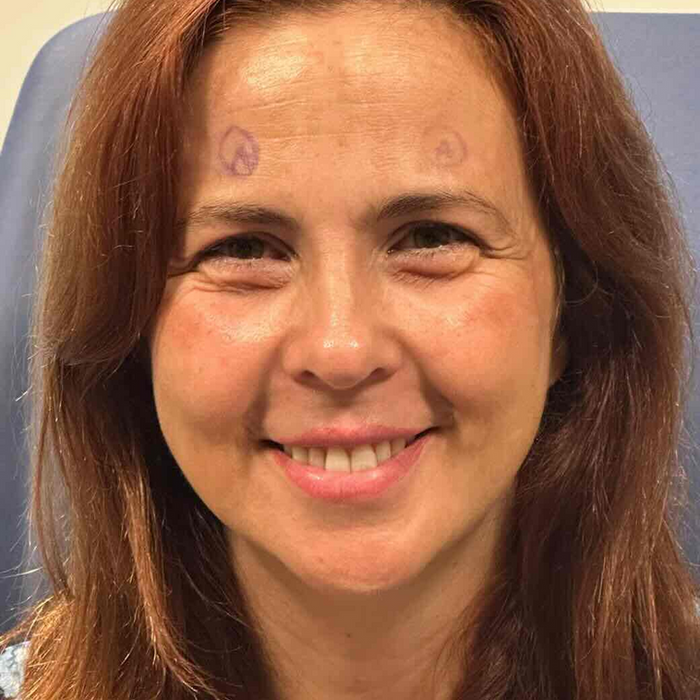 Bewertungen zu Trifokallinsenimplantaten in der Türkei