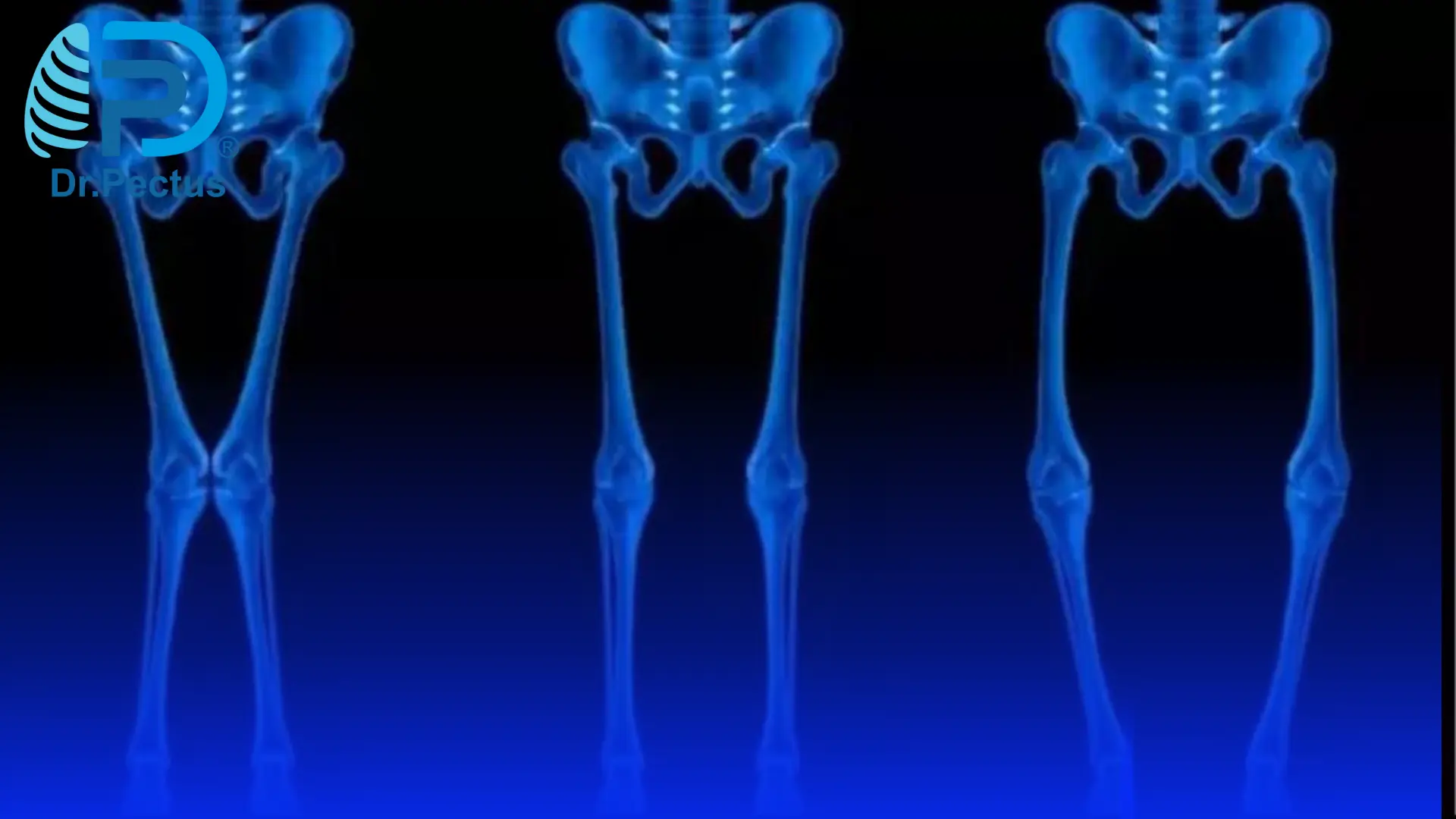 Pectus Excavatum (Sunken Chest) Causes and Risk Factors