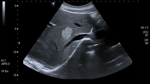 Gewöhnlich gut umschriebene, homogene, hypoechoic lesion (blass)