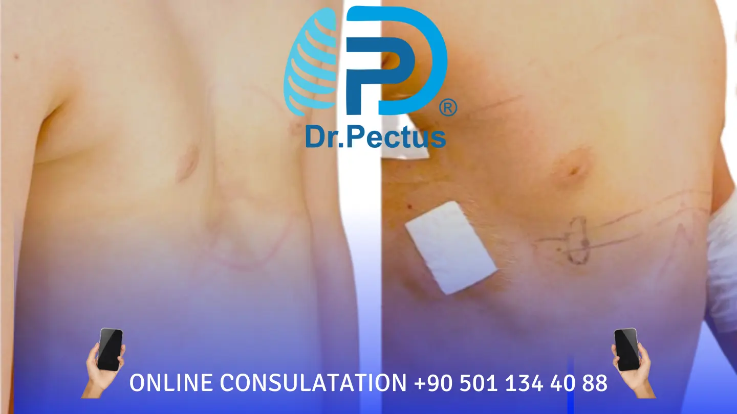 pectus excavatum surgery prices in turkey