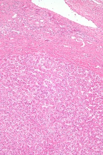 Ballooned hepatocytes with small and regular nuclei