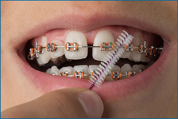 Tips-to-care-teeth-Braces-Advice-From-our-Orthodontist-in-Dubai-front.jpg