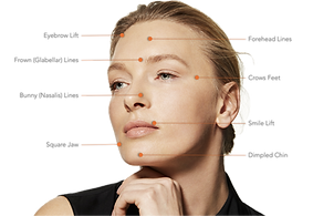 Dermal Filler Site Options