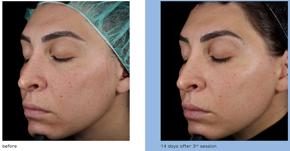 Croma Revitalis before / after for fine eye lines.