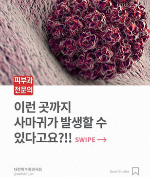 사마귀 종류와 발생하는곳