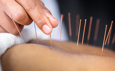 Woman getting Acupuncture