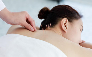 Woman getting Acupuncture