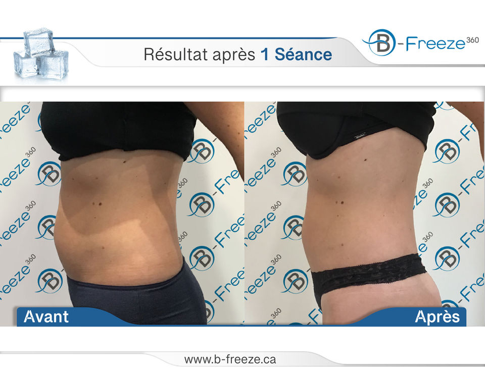 Transformation de la silhouette après 1 séance B-Freeze chez Santé et Beauté Luxury, avec un ventre visiblement plus plat et une taille affinée.