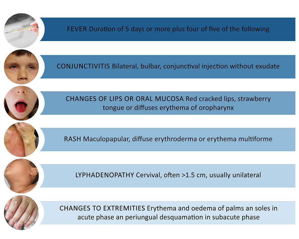 The contemporary treatment challenges in acute Kawasaki disease