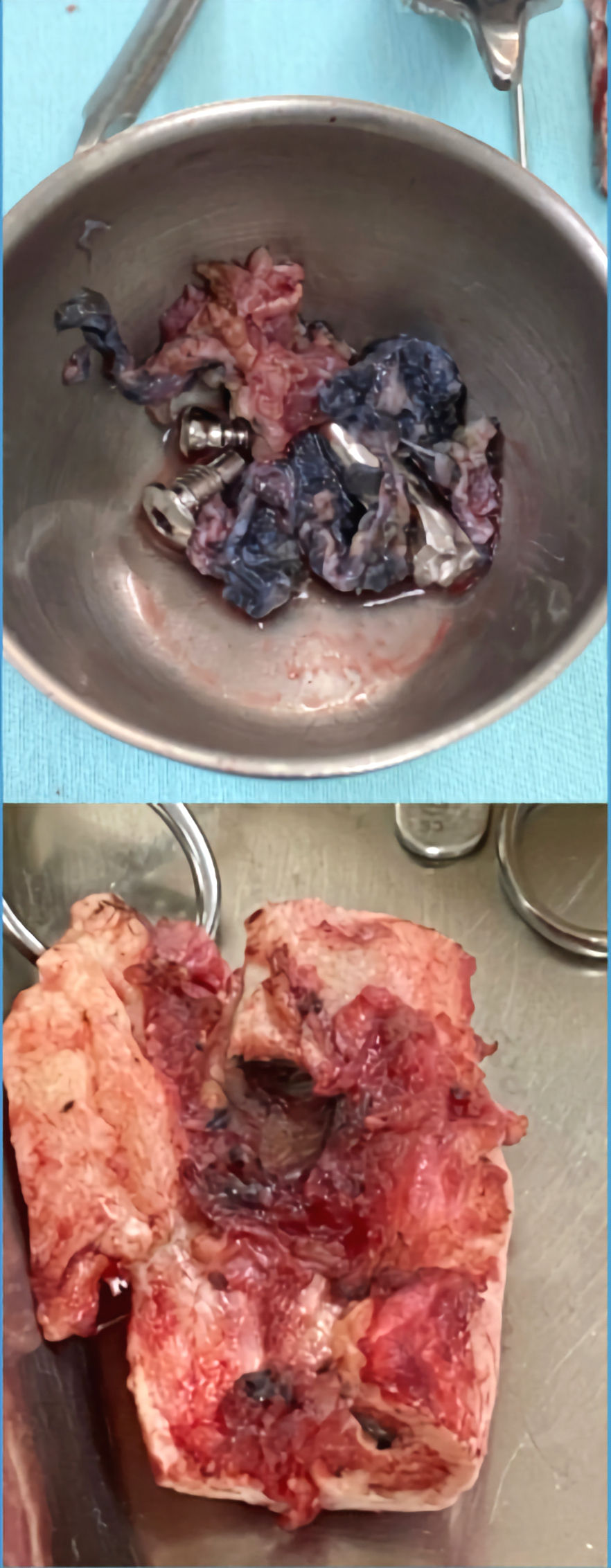 Ressecção do segmento ósseo infectado e todos os implantes