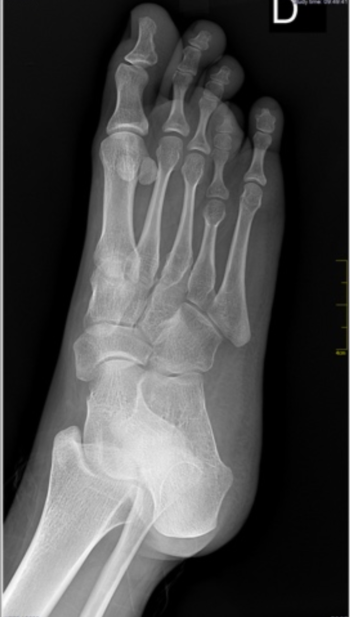 Braquimetatarsia IV podáctilo