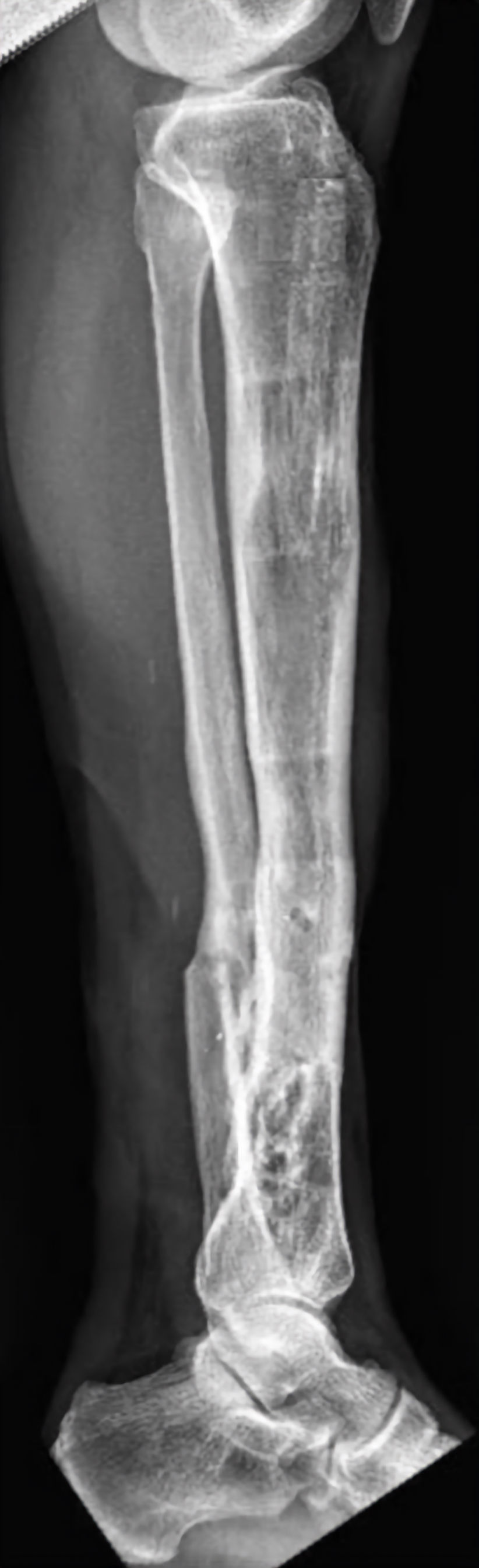 Consolidação sem infecção e eixos corrigidos