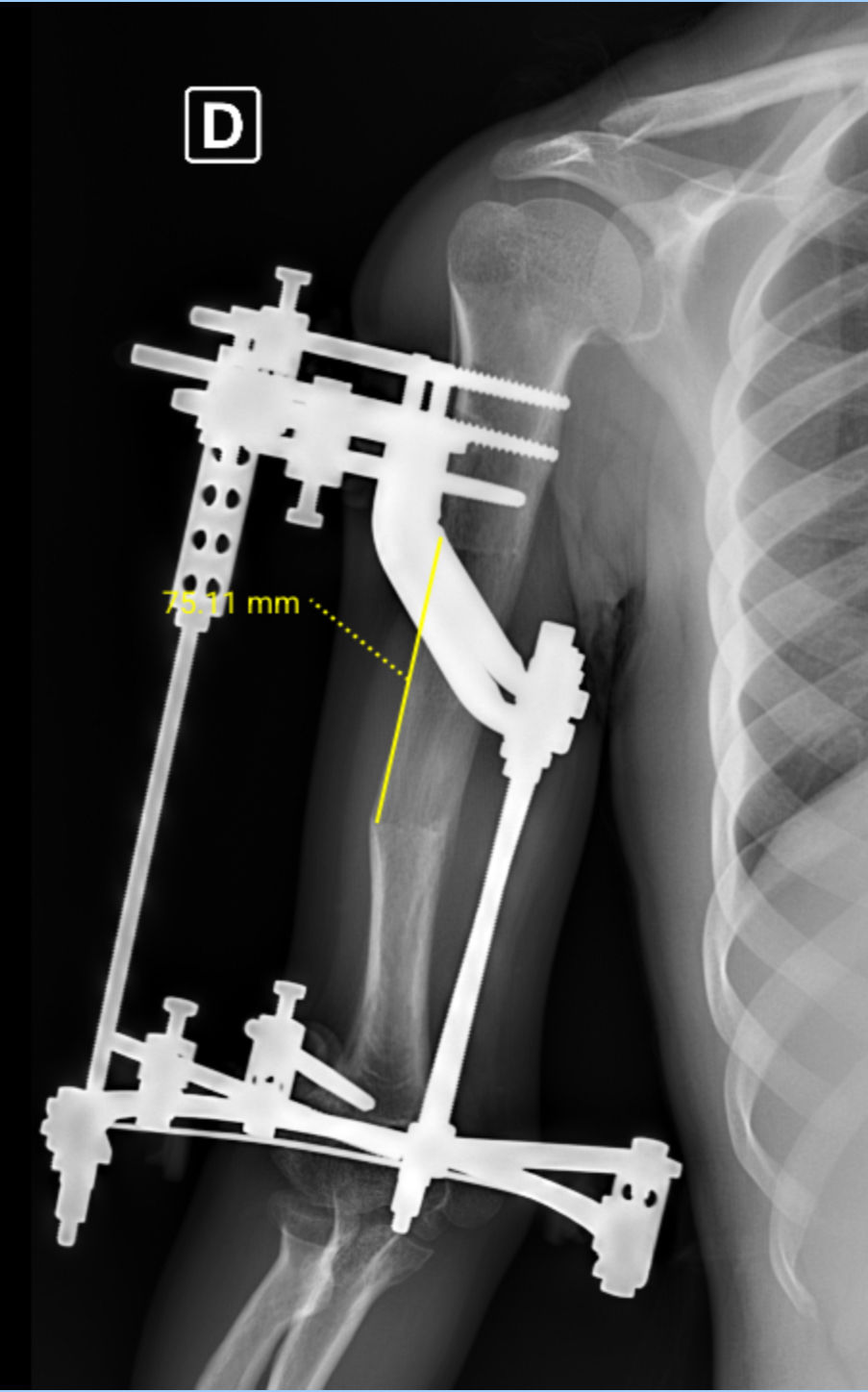 Alongamento braço Direito AP