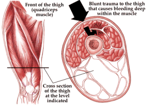 Muscle Contusion (1)