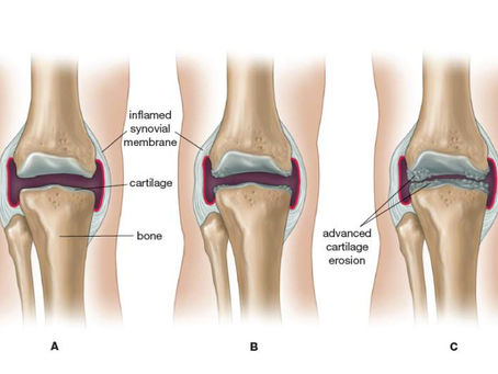 Arthritis and how massage can help