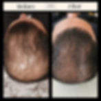 Exosome hair therapy revitalizes hair follicles, enhancing growth and density_